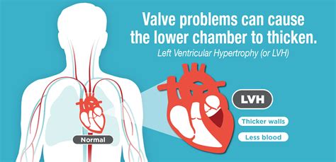 problems with left ventricle.